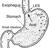 Illustration showing the location of the LES between the esophagus and the stomach